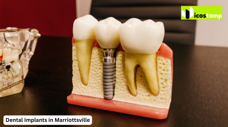 Dental Implants in Marriottsville